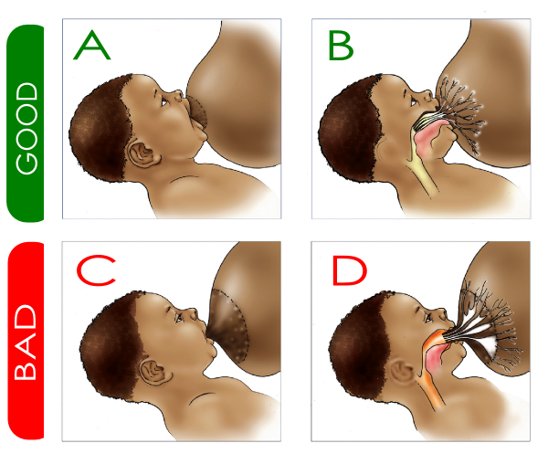 cách chữa nôn trớ cho trẻ sơ sinh