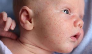Những thông tin cần biết khi trẻ sơ sinh dị ứng sữa mẹ