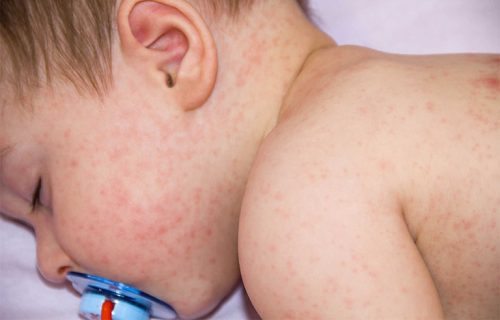 trẻ ngứa sốt là do nguyên nhân gì?