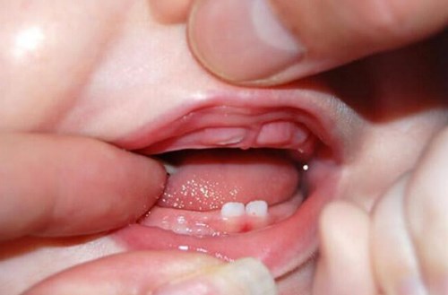 Một số lưu ý chăm sóc trẻ bị nôn trớ khi mọc răng đúng cách